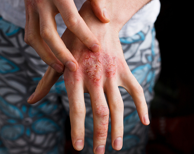 Атопический дерматит: с какими заболеваниями ожидаем сильную связь?