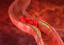 Распространенность атеросклеротических бляшек высокого риска осложнений у асимптомных пациентов со стенозом сонных артерий