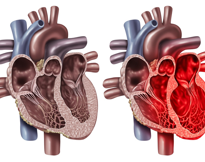 Место бета-блокаторов в терапии синдрома Такацубо
