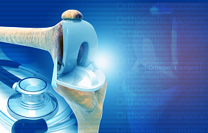 Бариатрическая хирургия помогает избежать осложнений эндопротезирования коленного сустава