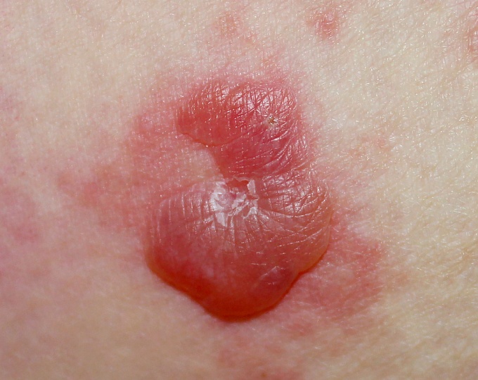 Обязательно ли наличие кожных булл для установления диагноза пемфигоида? 