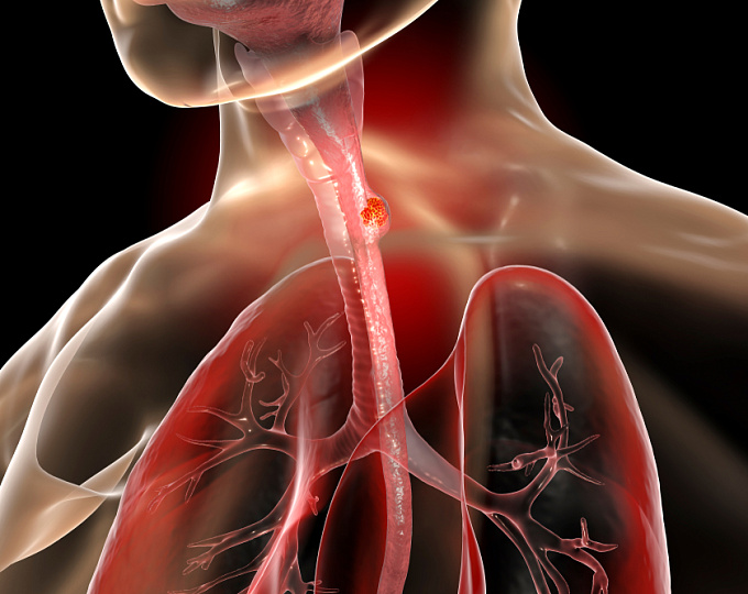 Можно ли считать эозинофильный эзофагит фактором риска рака пищевода?