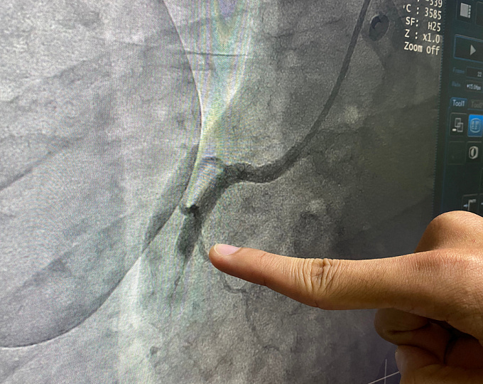 Целесообразноcть коронароангиографии после остановки сердца без ИМспST