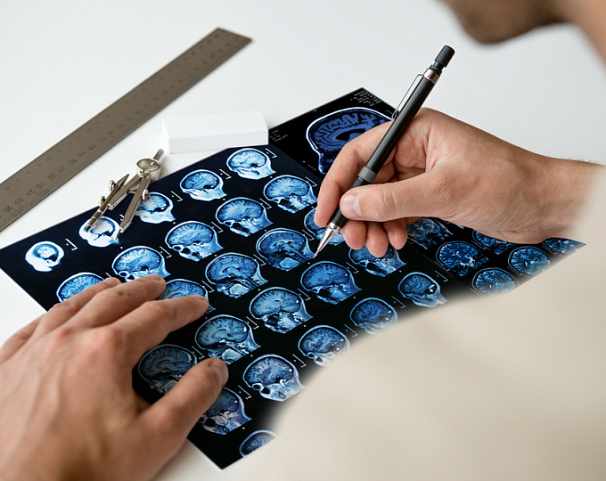 Влияние рассеянного склероза на слуховой и вестибулярный аппарат.