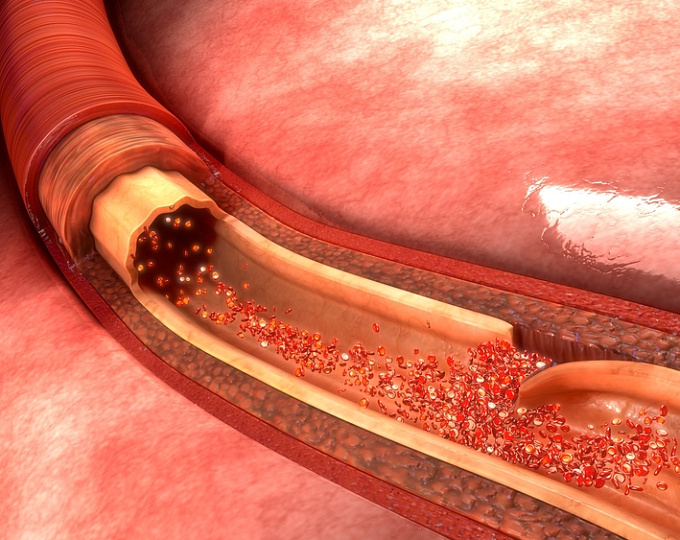 Исходы пациентов со спонтанной диссекцией коронарной артерии