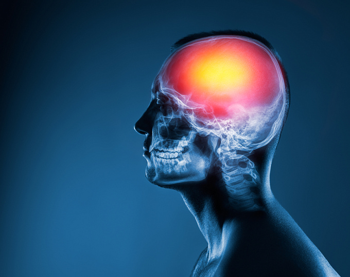 Внутричерепные микрокровоизлияния у пациентов разного пола