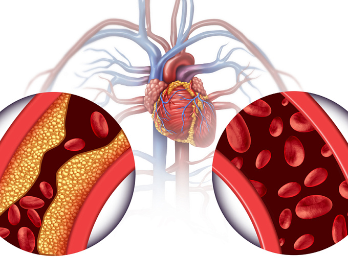 Фиброз печени и сердечно-сосудистый риск