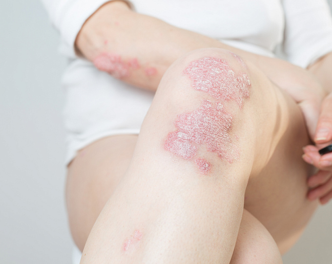 Распространенность метаболического синдрома у пациентов с псориатическим артритом