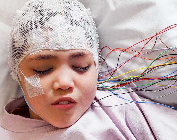 Терапия второй линии при эпилептическом статусе у детей