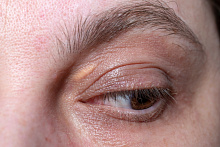 Xanthelasma Palpebrarurm не ассоциирована с развитием сердечно-сосудистых заболеваний