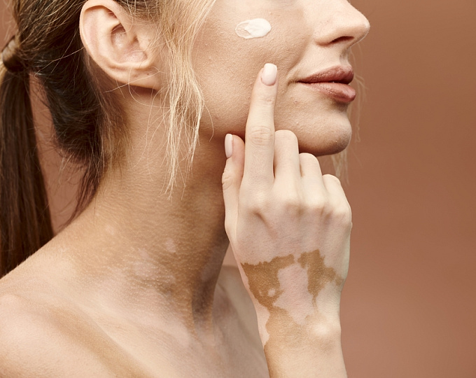 Эффективность и безопасность ингибитора янус-киназ при витилиго