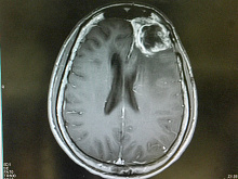 Прогноз пациентов с первичной глиобастомой спинного мозга
