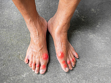 Лечение подагры и снижение риска сердечно-сосудистых осложнений