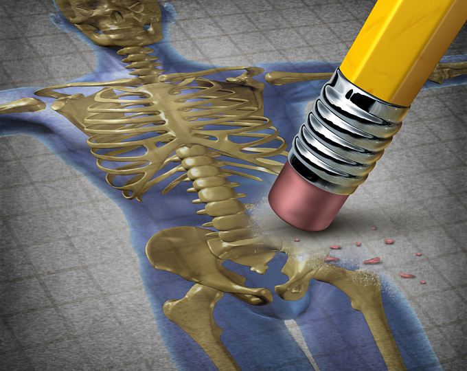 Как предотвратить потерю костной плотности при лечении ингибиторами ароматазы?