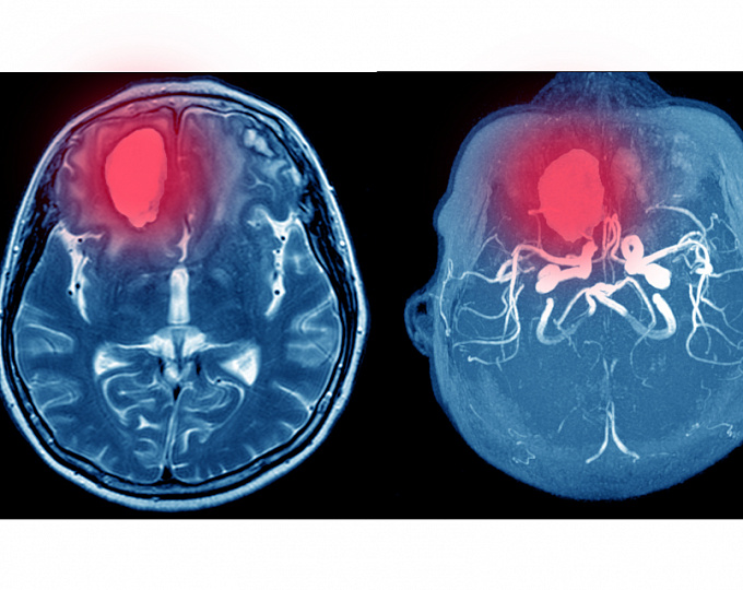 Открытое овальное окно и криптогенный инсульт у пожилых пациентов