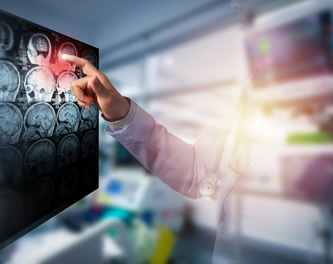 Как изменяются когнитивные функции в раннем постинсультном периоде?