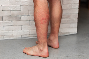 Факторы риска рецидива АНЦА-ассоциированного васкулита