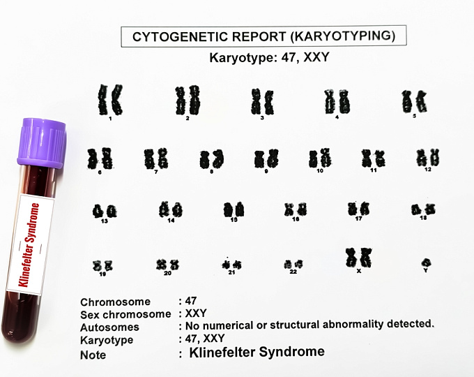 Метаболический профиль пациентов с синдромом Клайнфельтера