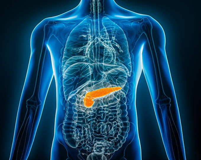 Связь между сахарным диабетом 2 типа и риском развития кист поджелудочной железы