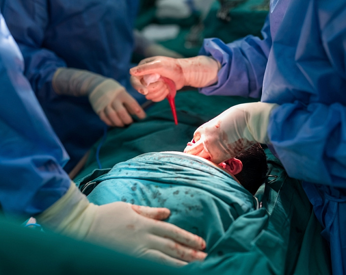 Риски для ментального здоровья после выполнения кесарева сечения под общей анестезией