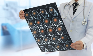 ХС-ЛПВП и прогноз пациентов с ишемическим инсультом