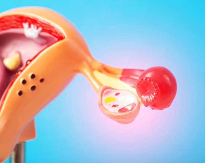 Повышение риска рака яичников у женщин с синдромом раздраженного кишечника