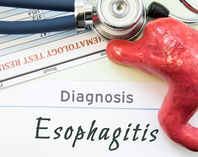 Дупилумаб в лечении эозинофильного эзофагита у пациентов старше 12 лет