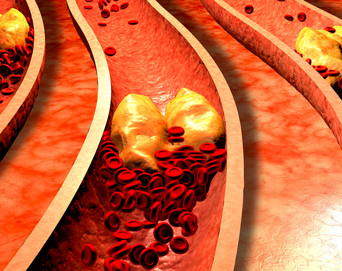 Как гипертония влияет на исходы пациентов с семейной гиперхолестеринемией?