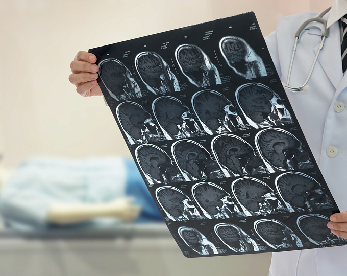 Связь между уровнем глюкозы крови натощак и инсультом