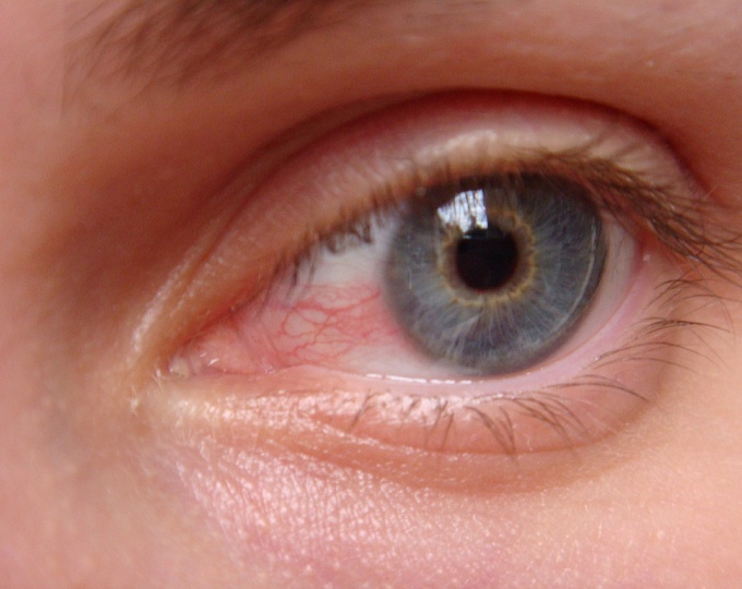 Факторы, ассоциированные с прогрессией синдрома сухого глаза 