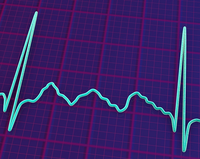 Фибрилляция предсердий и риск внезапной сердечной смерти у молодых людей