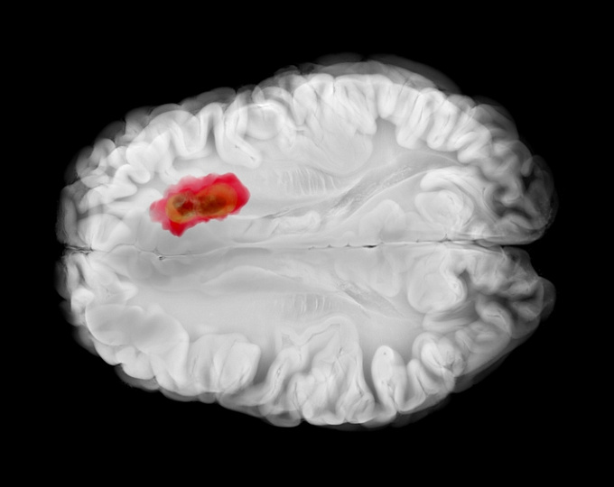 Как влияют ИПП на выживаемость у пациентов с глиобластомой?