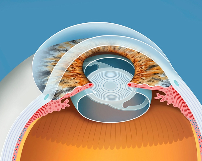 Как связаны между собой дефицит витамина D и катаракта?