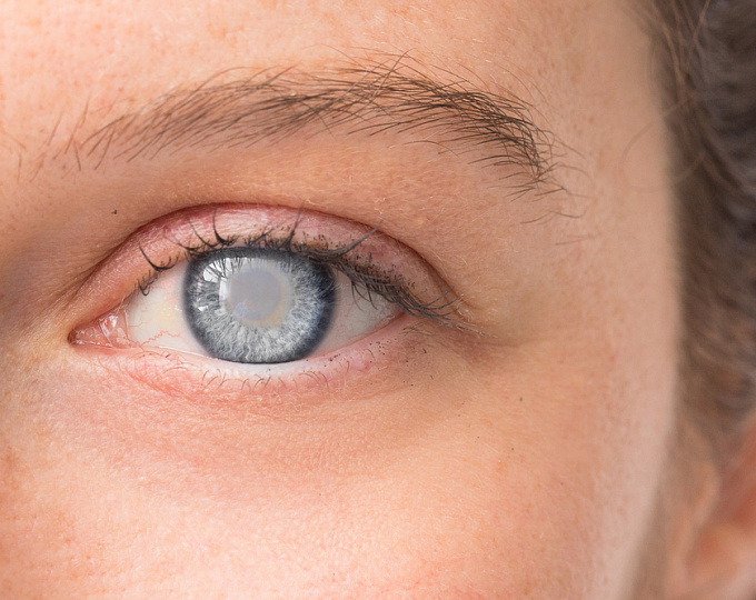 Частота и факторы риска послеоперационного помутнения хрусталика после хрусталик-сохраняющей витрэктомии при ретинопатии недоношенных.