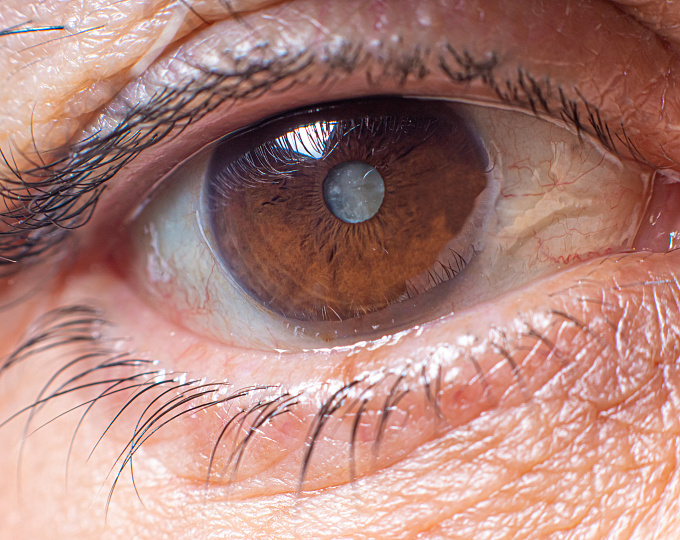 Показатели жесткости роговицы могут служить прогностическим фактором структурных и функциональных изменений при глаукоме в подозрительных глазах