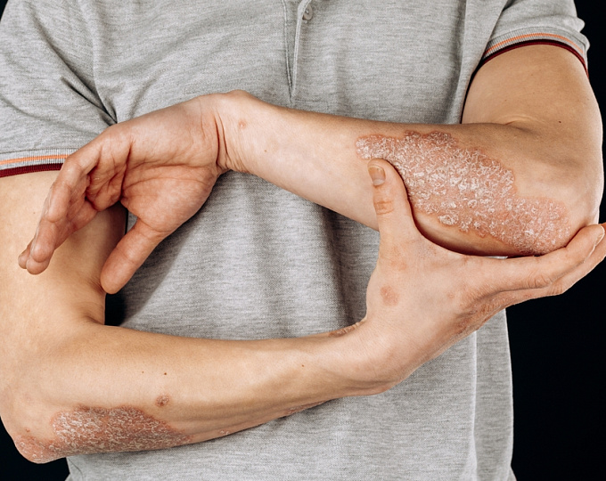 Выбор оптимальной лекарственной терапии при раннем псориатическом артрите