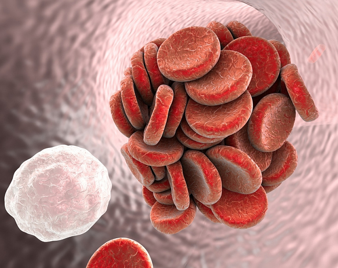 Может ли тромболизис привести к миграции кровяного сгустка?
