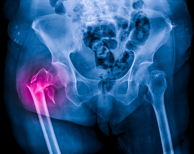 Метотрексат-ассоциированная остеопатия и риск переломов 