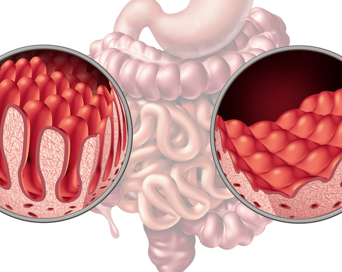 Целиакия у матери не повышает частоту врожденных пороков развития сердца у детей