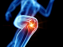 Травма коленного сустава как фактор риска остеоартрита в будущем