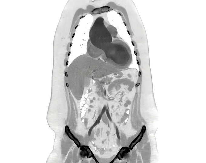 Замена аортального или наблюдение у пациентов с бессимптомным тяжелым аортальным стенозом
