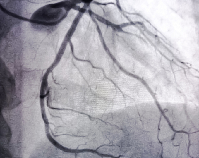 Внутривенный иммуноглобулин в лечении болезни Кавасаки