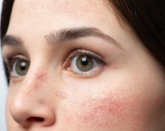 Роль витаминов и минералов в терапии розацеа