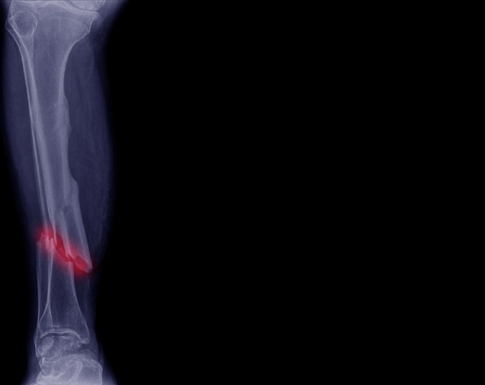 Препараты против остеопороза продлевают жизнь после перелома