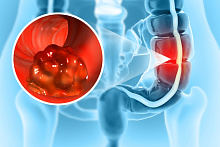 Факторы риска левосторонних и правосторонних неоплазий толстой кишки