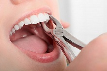Обосновано ли использование хлоргексидина перед экстракцией зуба?