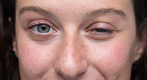 Течение myasthenia gravis во время беременности и после родов