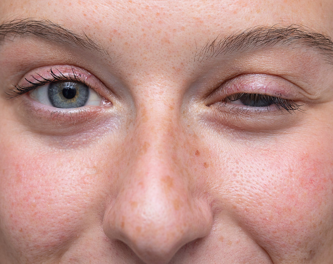 Течение myasthenia gravis во время беременности и после родов