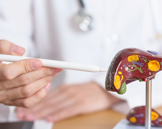 Мировая распространенность МАЖБП-ассоциированного цирроза