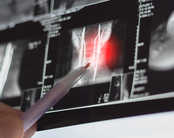 Сравнение эффективности ингибитора интердейкина-17A секукинумаба и ингибитора ФНО-альфа при спондилоартрите